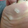 鸡眼患者的平时要注意