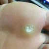 鸡眼的表现方面