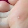 鸡眼的好发人群以及患病了怎么办