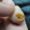 鸡眼的有很多治疗的方式