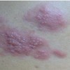 为什么带状疱疹会引起剧痛