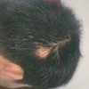 斑秃吃什么比较好