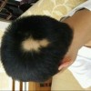 斑秃患者的营养补充须知