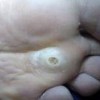 鸡眼症状有什么如何辨别