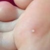与鸡眼容易混淆的疾病有哪些