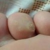 鸡眼诊断过程的简介
