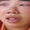 皮肌炎的护理措施有哪些呢