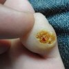 鸡眼形成的原因比较多