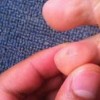 详谈长鸡眼后应该怎么办