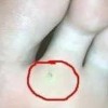 脚底长鸡眼怎么办