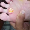 鸡眼是一种什么病