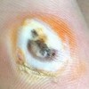 那么手上长鸡眼怎么办