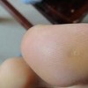 治疗鸡眼的方法往往比较传统