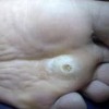 有什么好的办法可以去鸡眼吗