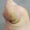 去除鸡眼的方法是什么