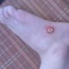 治疗鸡眼的九个偏方