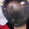 如何防止斑秃疾病