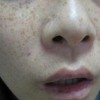 雀斑容易和哪些斑混淆