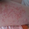 荨麻疹在什么季节比较容易犯病？