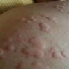 压力性荨麻疹的介绍