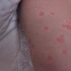 荨麻疹的早期症状有哪些呢