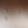 儿童荨麻疹出现的特征有哪些