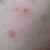 皮肤荨麻疹如何护理