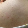 粉刺和痤疮的区别