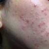 粉刺和痤疮的区别在哪里