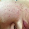 痤疮与粉刺是不是同其中一种的