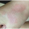 为什么会得脓疱型银屑病呢