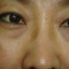 如何正确预防黄褐斑