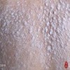 银屑病和遗传的原因有关吗