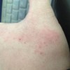 秋季警惕银屑病高发