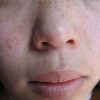 黄褐斑如何防止才有效