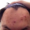 粉刺有什么危害