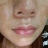 黄褐斑具体有哪些表现
