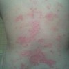 怎么鉴别银屑病与玫瑰糠疹