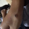 寻常疣的致病因素有什么