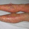 银屑病患者应该注意哪些