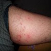 银屑病患者秋冬季节特别注意