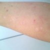 秋季银屑病患者该如何正确使用化妆品