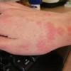 荨麻疹患者该如何饮食
