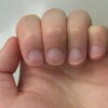 甲沟炎家庭护理措施是什么