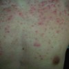 面部毛囊炎的症状表现有哪些