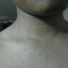 男性阴毛囊炎症状是怎样的