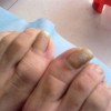甲沟炎为什么会反复发作呢