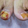 容易得甲沟炎是什么原因呢