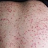 毛囊炎患者饮食注意什么