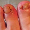 手指甲沟炎有哪些症状